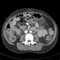 Biliary necrosis - liver transplant (Radiopaedia 21876-21846 B 39).jpg