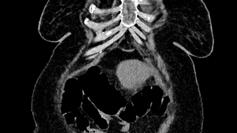 File:Biliary pancreatitis (Radiopaedia 72289-82823 Coronal non-contrast 12).jpg
