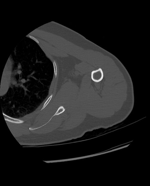 File:Bizarre parosteal osteochondromatous proliferation (Radiopaedia 84221-99501 Axial bone window 15).jpg