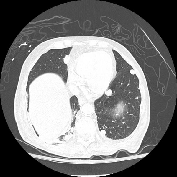 File:Bladder cancer metastases (Radiopaedia 9824-10409 Axial lung window 8).jpg