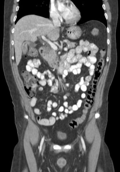 File:Bleeding duodenal ulcer and adenomyomatosis of gallbladder (Radiopaedia 61834-69861 B 52).jpg