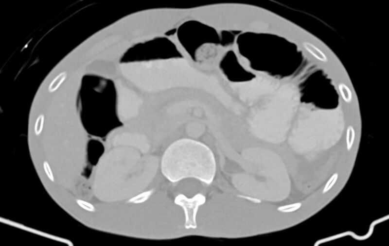 File:Blunt injury to the small bowel (Radiopaedia 74953-85987 Axial Wide 25).jpg