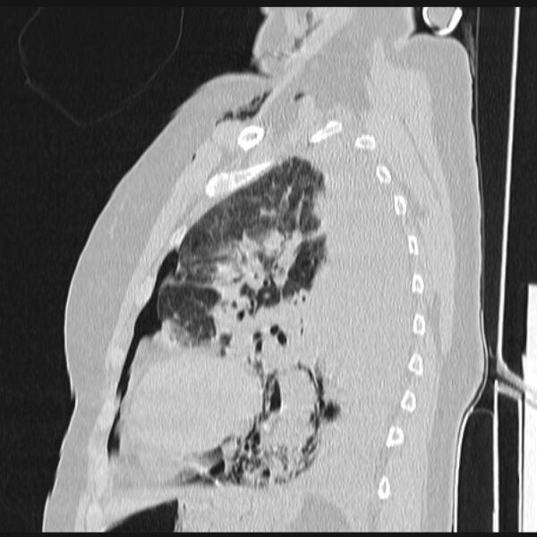 File:Boerhaave syndrome (Radiopaedia 45644-49799 Sagittal lung window 58).jpg
