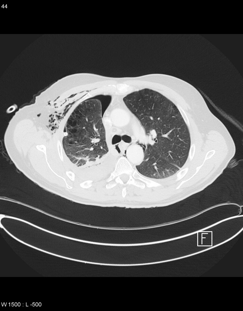 Boerhaave syndrome with tension pneumothorax (Radiopaedia 56794-63605 Axial lung window 21).jpg