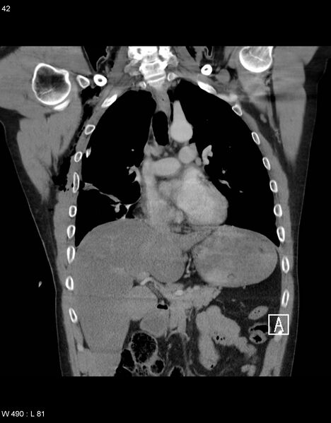 File:Boerhaave syndrome with tension pneumothorax (Radiopaedia 56794-63605 B 16).jpg