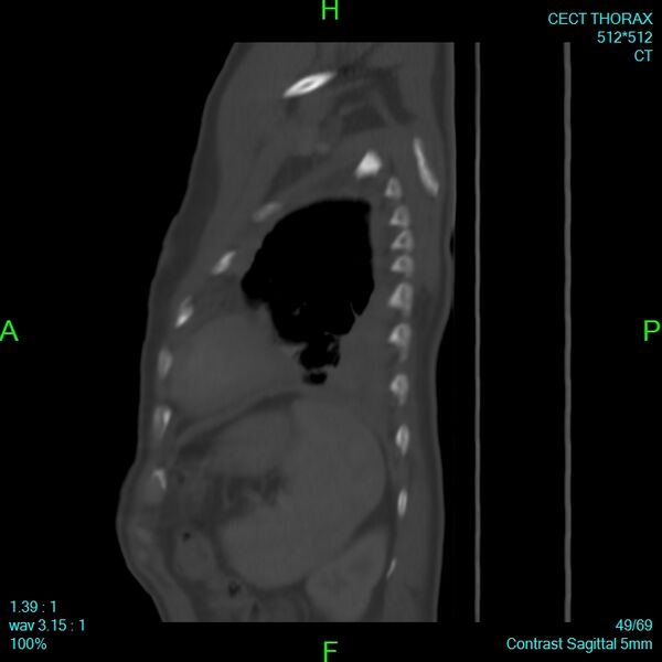 File:Bone metastases from lung carcinoma (Radiopaedia 54703-60937 Sagittal bone window 49).jpg