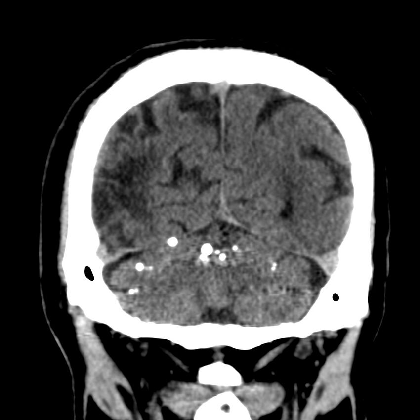 Brain Pantopaque remnants (Radiopaedia 78403-91048 Coronal non-contrast 55).jpg