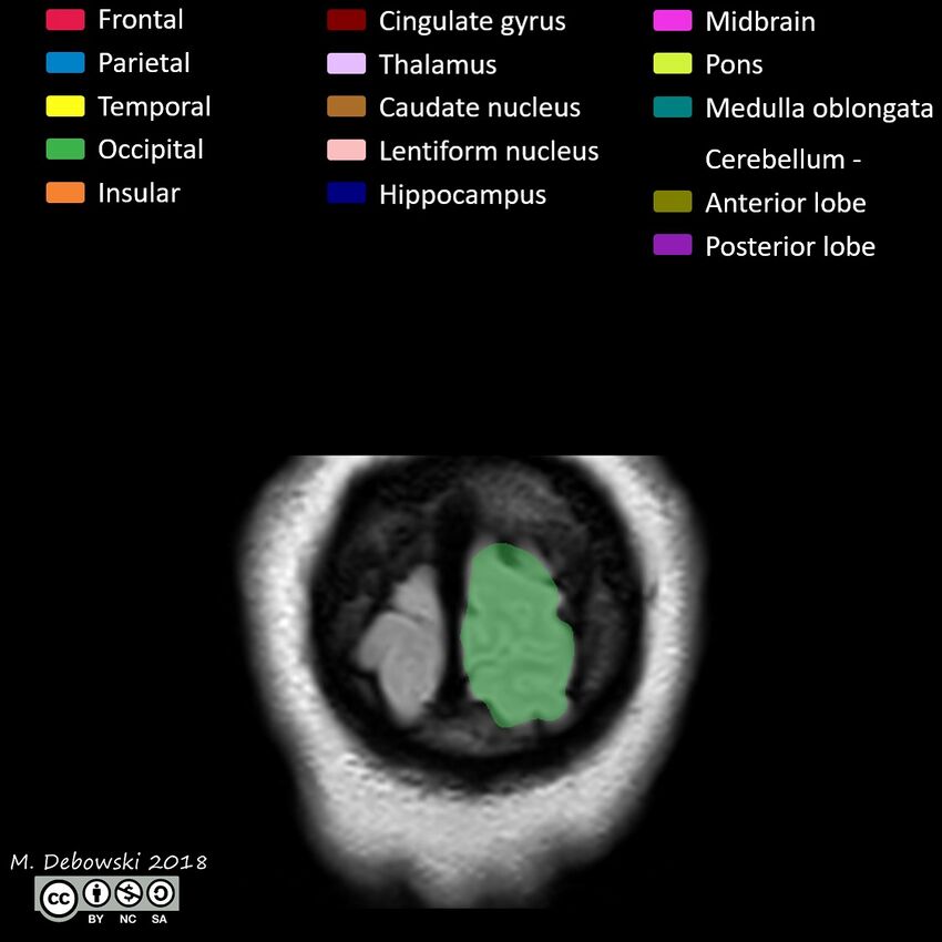 Brain lobes - annotated MRI (Radiopaedia 61691-69700 Coronal 74).JPG