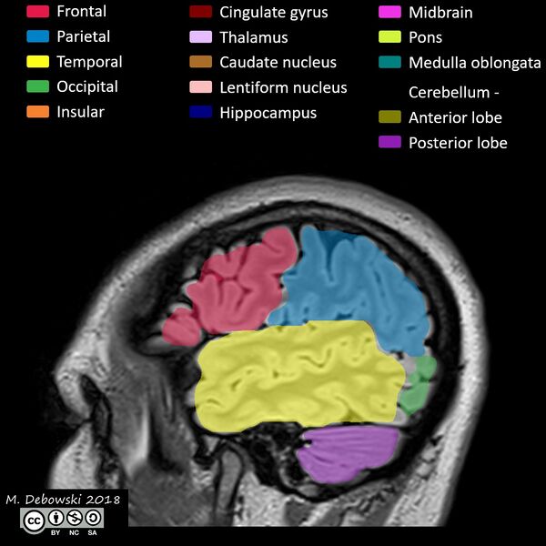 File:Brain lobes - annotated MRI (Radiopaedia 61691-69700 Sagittal 69).JPG
