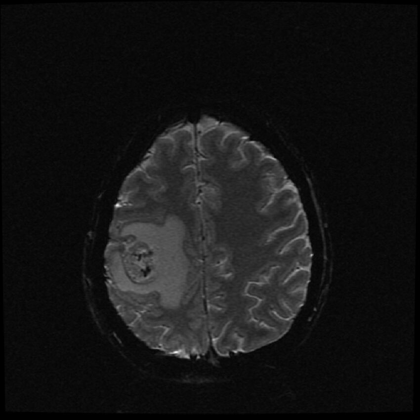 Brain metastases (renal cell carcinoma) (Radiopaedia 42571-45704 Axial SWI 12).jpg