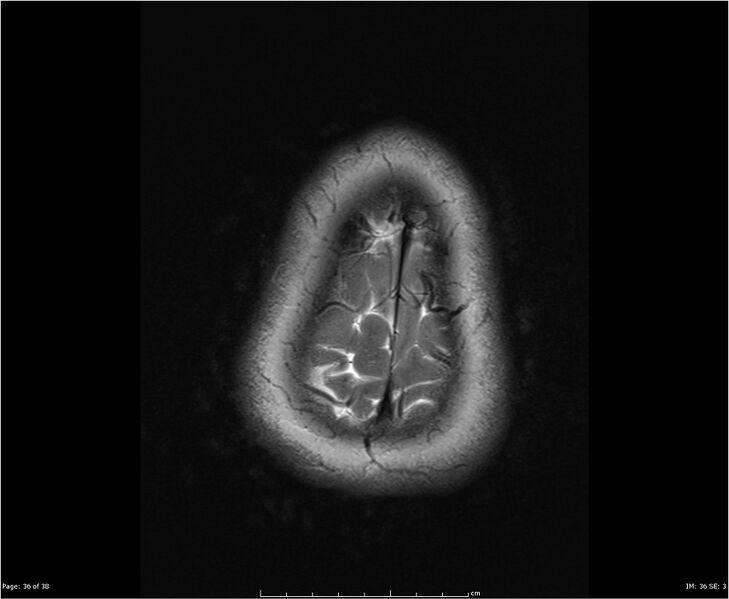 File:Brainstem glioma (Radiopaedia 21819-21775 Axial T2 36).jpg