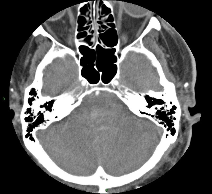 Brainstem hemorrhage (Radiopaedia 58794-66028 D 47).jpg