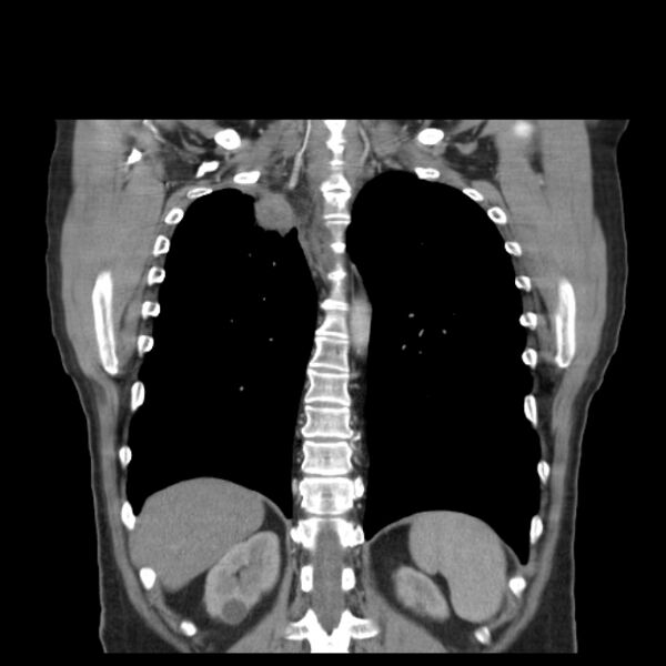 File:Bronchogenic carcinoma with upper lobe collapse (Radiopaedia 29297-29726 D 40).jpg