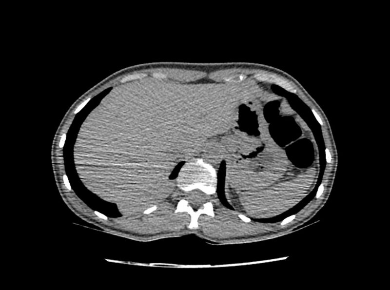 File:Bronchogenic cyst (Radiopaedia 80273-93615 C 41).jpg