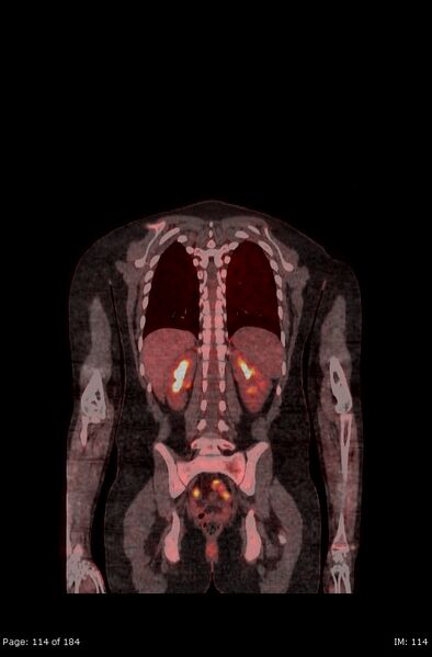 File:Brown fat uptake (FDG PET-CT) (Radiopaedia 77392-89513 Fused coronal 72).jpg