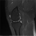Bucket handle tear - lateral meniscus (Radiopaedia 7246-8187 Sagittal T2 fat sat 17).jpg