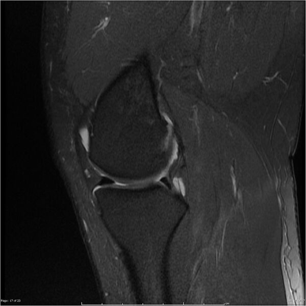 File:Bucket handle tear - lateral meniscus (Radiopaedia 7246-8187 Sagittal T2 fat sat 17).jpg