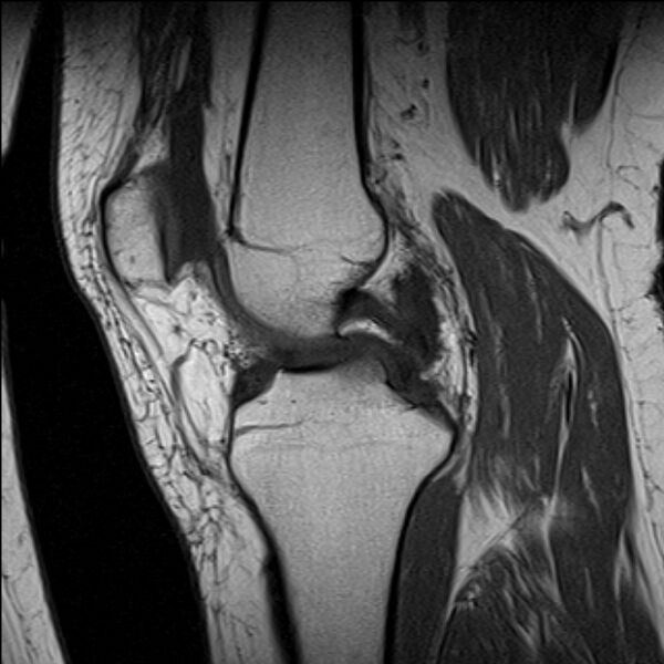 File:Bucket handle tear - medial meniscus (Radiopaedia 79028-91942 Sagittal T1 14).jpg