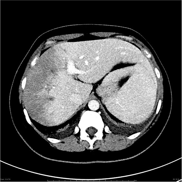 File:Budd-Chiari syndrome (Radiopaedia 27929-28177 Axial liver window 14).JPG