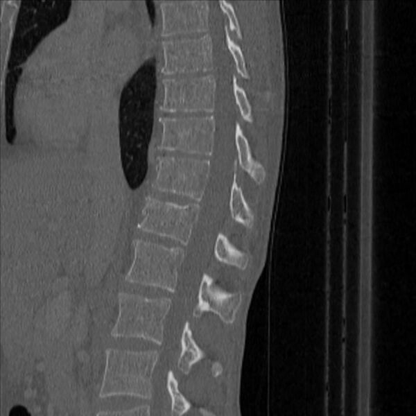 File:Bulging of paraspinal line in traumatic thoracal spinal compression fracture (Radiopaedia 29221-35872 Sagittal bone window 22).jpg