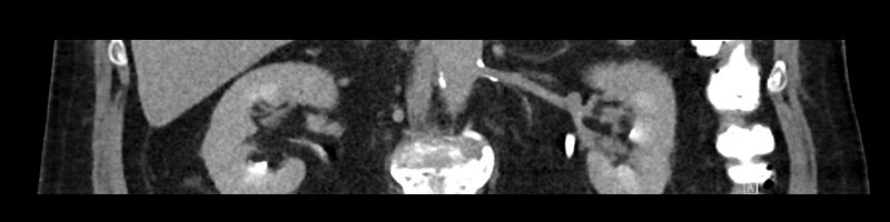 File:Buried bumper syndrome - gastrostomy tube (Radiopaedia 63843-72575 Coronal Inject 58).jpg