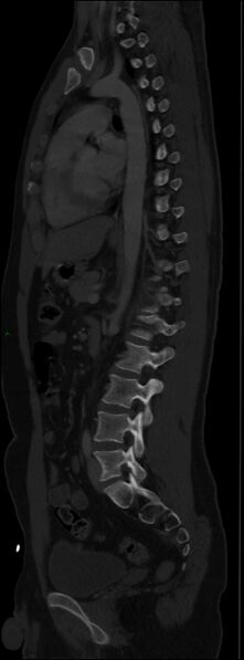 File:Burst fracture (Radiopaedia 83168-97542 Sagittal bone window 74).jpg