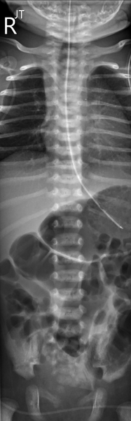 File:Butterfly vertebra and anal atresia (Radiopaedia 26084-26220 Frontal 1).png