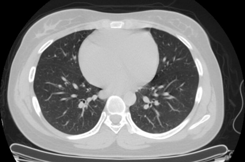 File:Cannonball metastases - uterine choriocarcinoma (Radiopaedia 70137-80173 Axial lung window 67).jpg