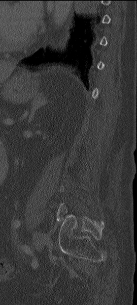 File:Cannonball metastases from endometrial cancer (Radiopaedia 42003-45031 H 13).png