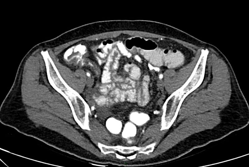 File:Carcinoid mesenteric tumor complicated by chylous ascites (Radiopaedia 76312-88926 A 60).jpg