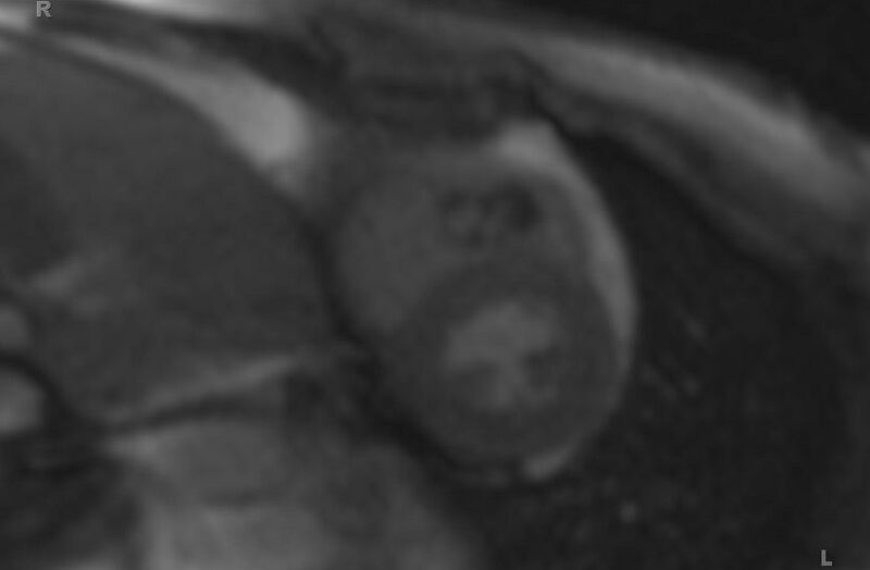 File:Cardiac hemangioma (Radiopaedia 31709-32631 E 43).jpg