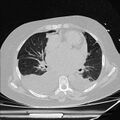 Cardiogenic pulmonary edema (Radiopaedia 29213-29609 Axial lung window 53).jpg