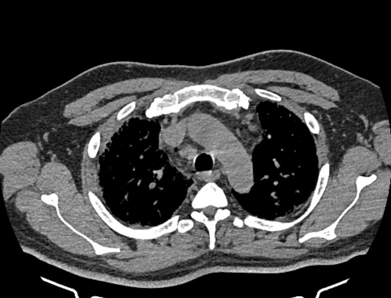 File:Cardiogenic pulmonary edema (Radiopaedia 68180-77678 Axial non-contrast 10).jpg