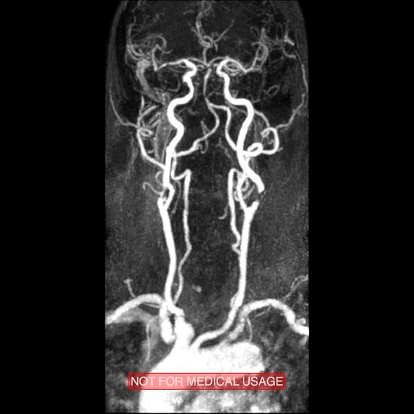 File:Carotid artery stenosis (Radiopaedia 28786-29087 3D MRA 9).jpg