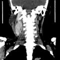 Carotid body tumor (Radiopaedia 27890-28124 B 5).jpg