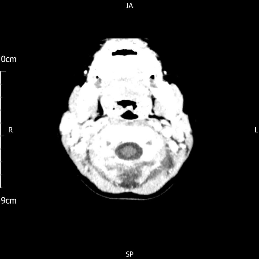 Cavernous sinus thrombosis (Radiopaedia 79414-92510 Axial Brain 32).jpg