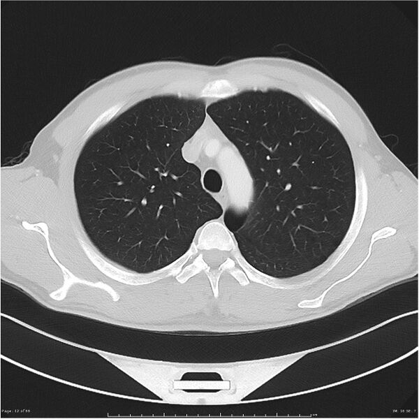 File:Cavitating lung cancer (Radiopaedia 25796-25945 Axial lung window 12).jpg