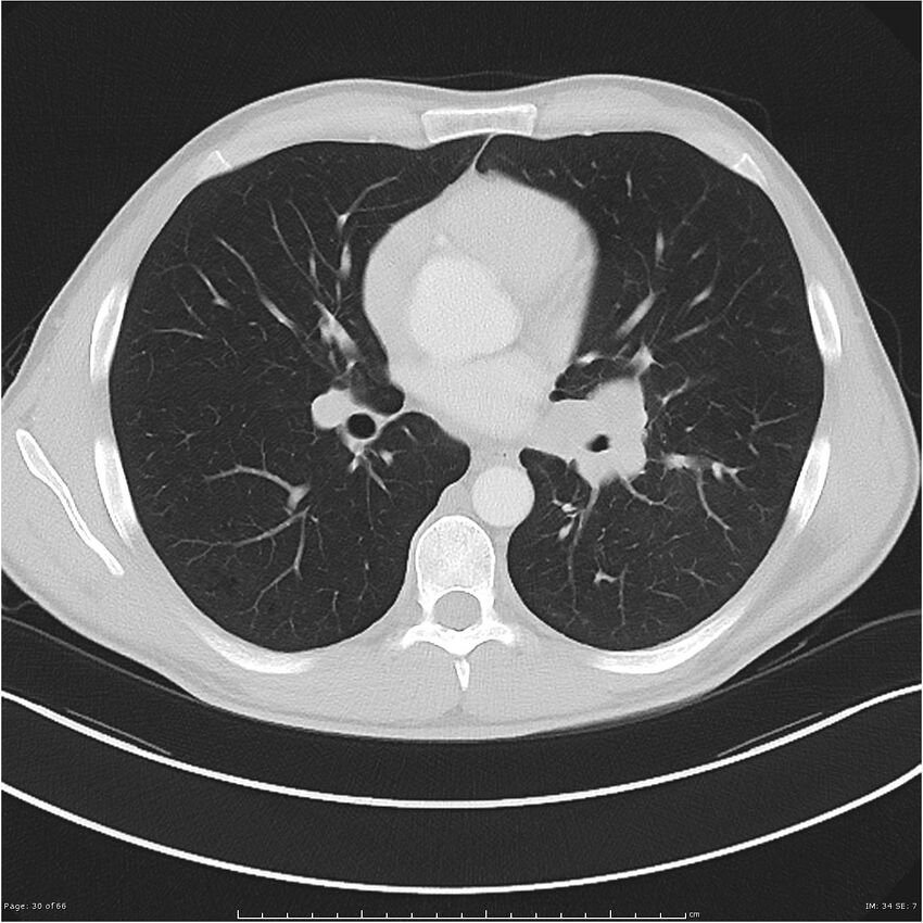 Cavitating lung cancer (Radiopaedia 25796-25945 Axial lung window 30).jpg