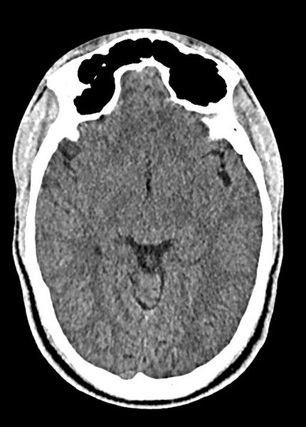 File:Cavum septum pellucidum and cavum vergae (Radiopaedia 77797-90060 Axial Brain Window 46).jpg