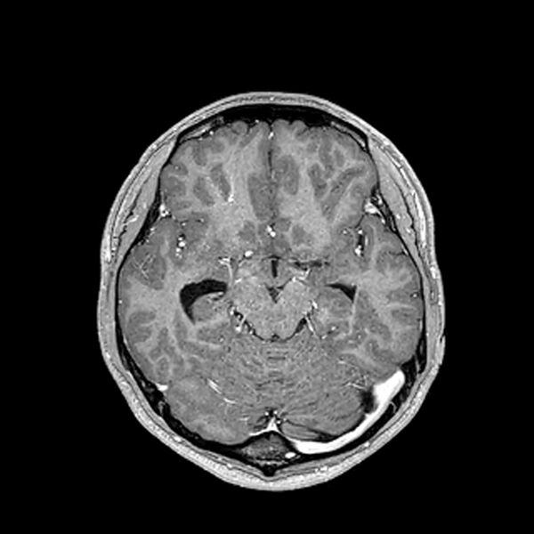 File:Central neurocytoma (Radiopaedia 79320-92380 Axial T1 C+ 104).jpg