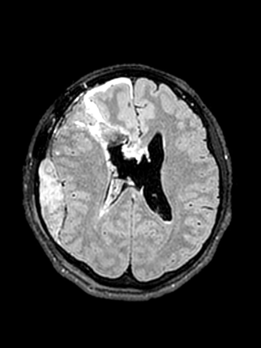 Central neurocytoma (Radiopaedia 79320-92381 Axial FLAIR 71).jpg