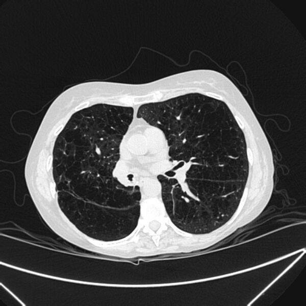 File:Centrilobular pulmonary emphysema (Radiopaedia 24495-24789 Axial lung window 49).jpg
