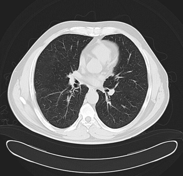 File:Centrilobular pulmonary emphysema (Radiopaedia 26808-26971 C 24).jpg