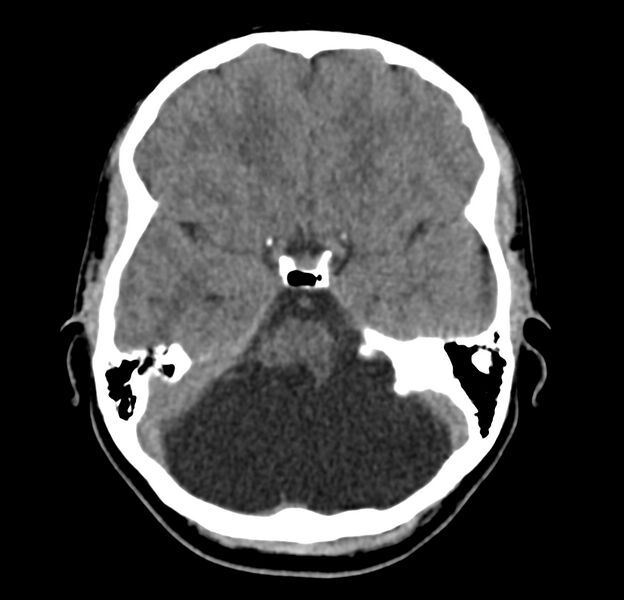 File:Cerebellar agenesis (Radiopaedia 30203-30817 Axial non-contrast 13).jpg