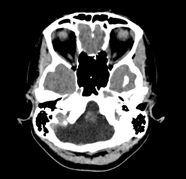 File:Cerebellar agenesis (Radiopaedia 30203-30817 Axial non-contrast 7).jpg
