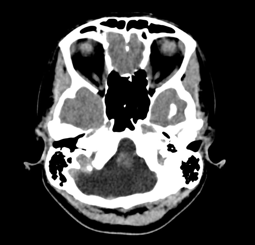Cerebellar agenesis (Radiopaedia 30203-30817 Axial non-contrast 7).jpg
