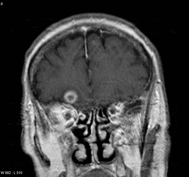 File:Cerebral absceses (Radiopaedia 4933-6838 Coronal T1 C+ 1).jpg