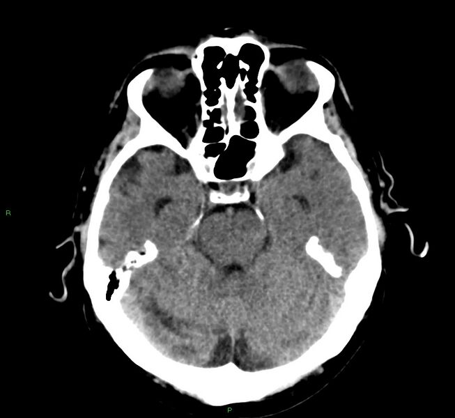 File:Cerebral amyloid angiopathy-associated lobar intracerebral hemorrhage (Radiopaedia 58376-65511 Axial non-contrast 39).jpg