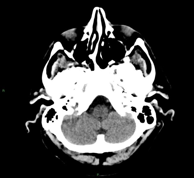 File:Cerebral amyloid angiopathy-associated lobar intracerebral hemorrhage (Radiopaedia 58376-65511 Axial non-contrast 47).jpg