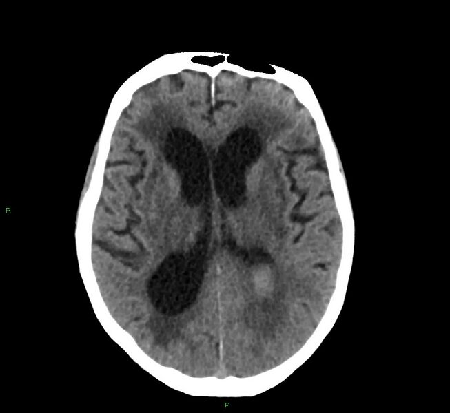 File:Cerebral amyloid angiopathy-associated lobar intracerebral hemorrhage (Radiopaedia 58530-65688 Axial non-contrast 23).jpg
